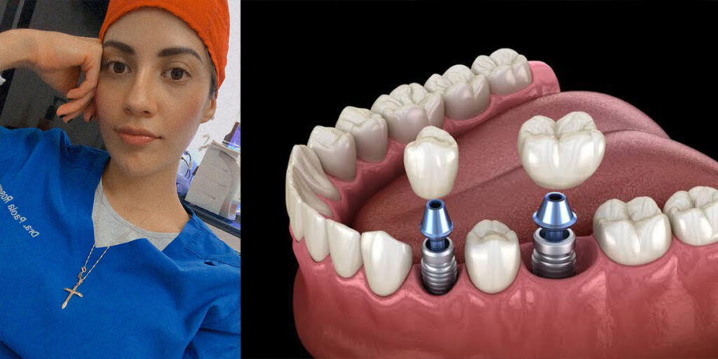 Implantes dentales