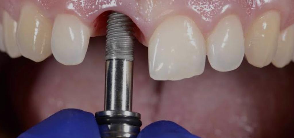 implantes dentales