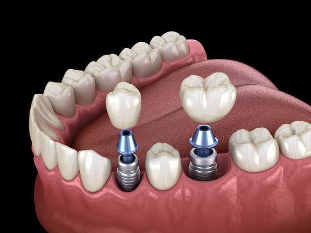 implantes dentales