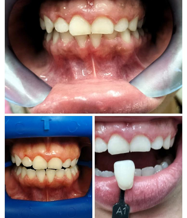 Antes y después de tratamiento de blanqueamiento dental. 