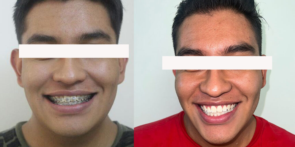 brackets antes y despues