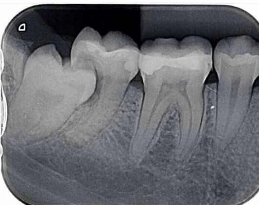 extracciones dentales en querétaro