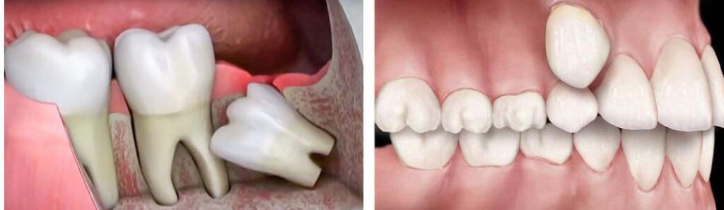 cirugias dentales de terceros molares